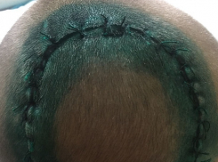 В новороссийской школе ребенку с пробитой головой  45 минут не вызывали «скорую»