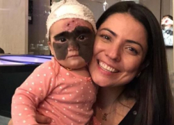 Девочке с «маской Бэтмена» сделали операцию на носу в Краснодаре