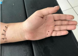 В Краснодаре медики сохранили пациенту двигательную активность поврежденной руки 