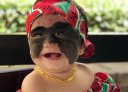 Врачи Краснодара сняли маску Бэтмена с лица маленькой американки