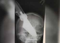 Кубанские медики извлекли 25-сантиметровый нож из головы 60-летней женщины