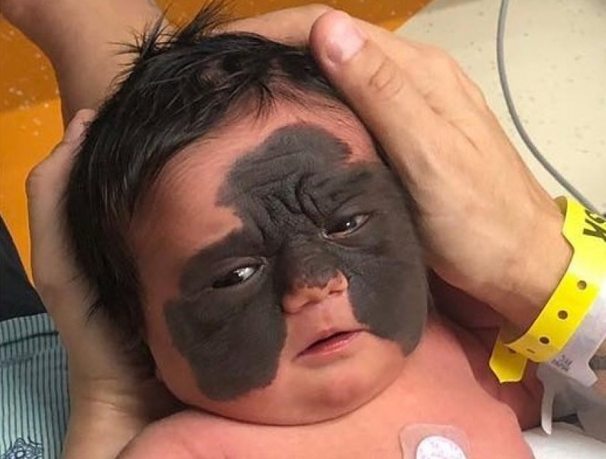Краснодарский врач анонсировал операцию американской девочке с «маской Бэтмена»