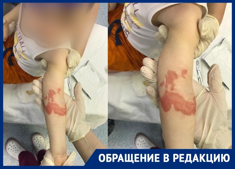 Ожог второй степени: кастрюлю с кипящим супом опрокинул на себя малыш в  детском саду Краснодара